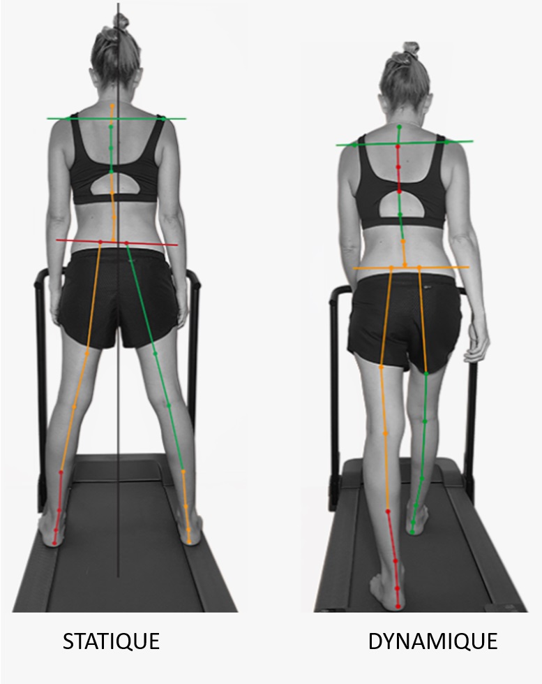 ÉVOLUTION DU LOGICIEL CLINIQUE OPS : UNE REVOLUTION DANS L'ANALYSE DE LA POSTURE 